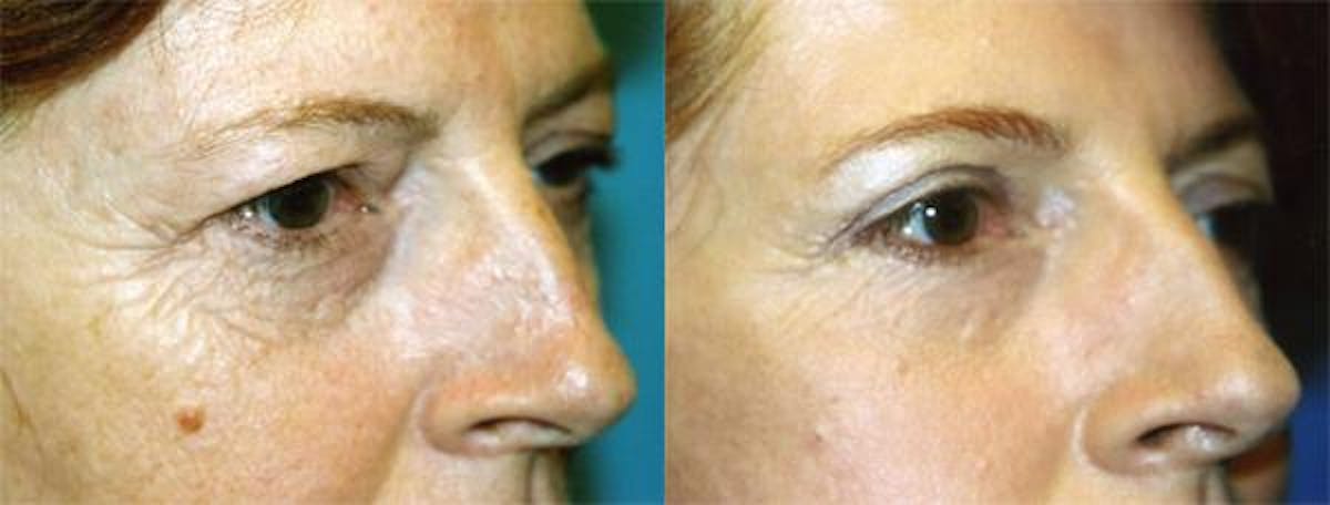 Eyelid Surgery Before & After Gallery - Patient 122405906 - Image 1