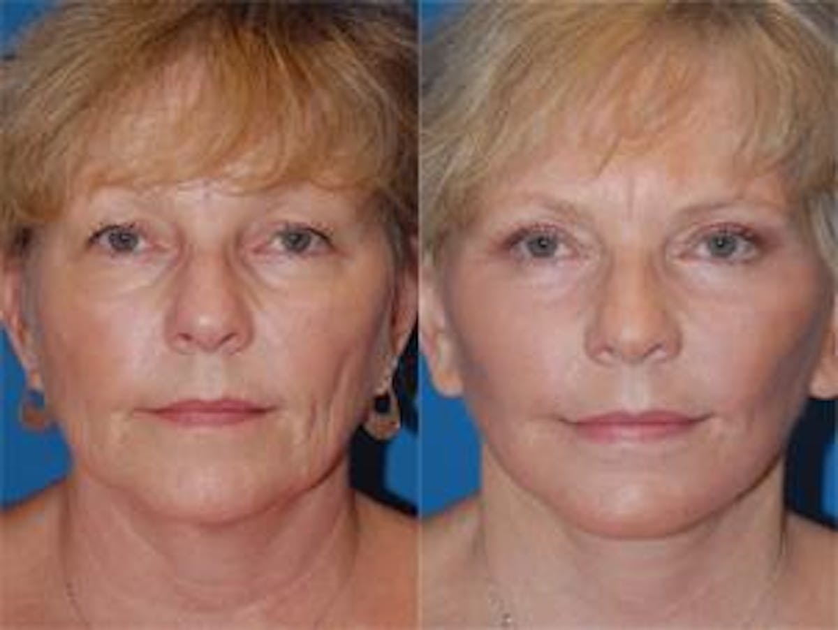 Facelift Before & After Gallery - Patient 122405908 - Image 1