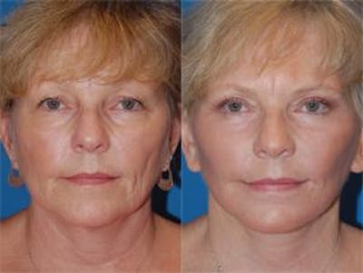 Facelift Before & After Gallery - Patient 122405908 - Image 1