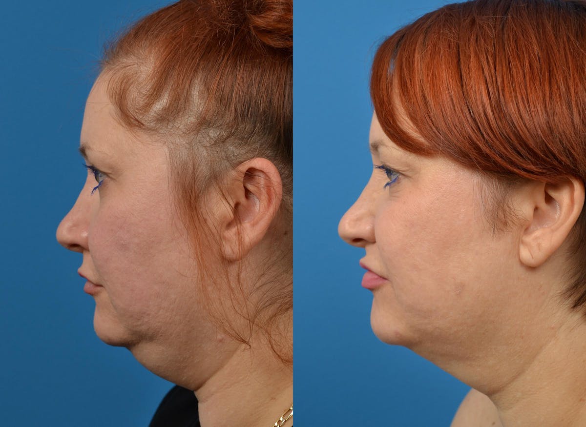 Kybella Before & After Gallery - Patient 122405909 - Image 5