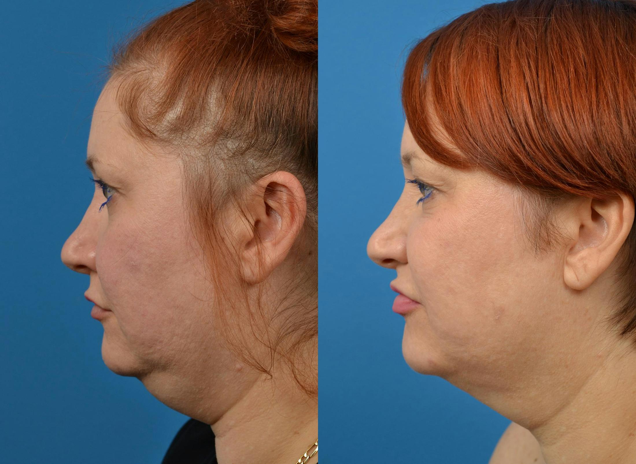 Kybella Before & After Gallery - Patient 122405909 - Image 5