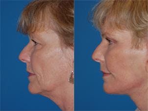 Facelift Before & After Gallery - Patient 122405908 - Image 2