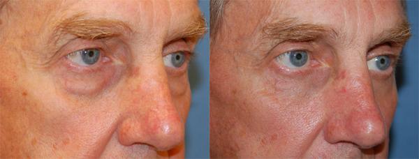Eyelid Surgery Before & After Gallery - Patient 380908 - Image 1