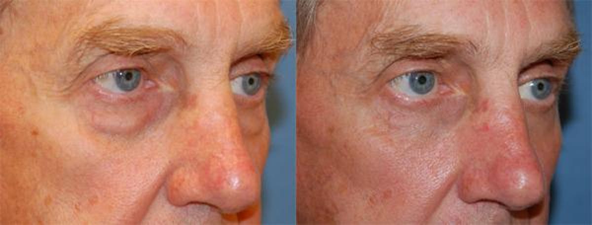 Eyelid Surgery Before & After Gallery - Patient 122405907 - Image 1