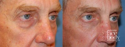 Eyelid Surgery Before & After Gallery - Patient 380908 - Image 1