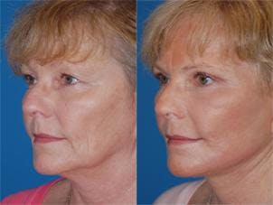 Facelift Before & After Gallery - Patient 122405908 - Image 3