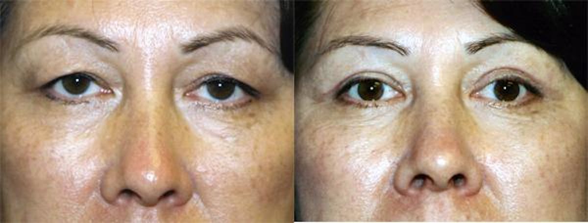 Eyelid Surgery Before & After Gallery - Patient 122405910 - Image 1