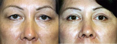 Eyelid Surgery Before & After Gallery - Patient 122405910 - Image 1