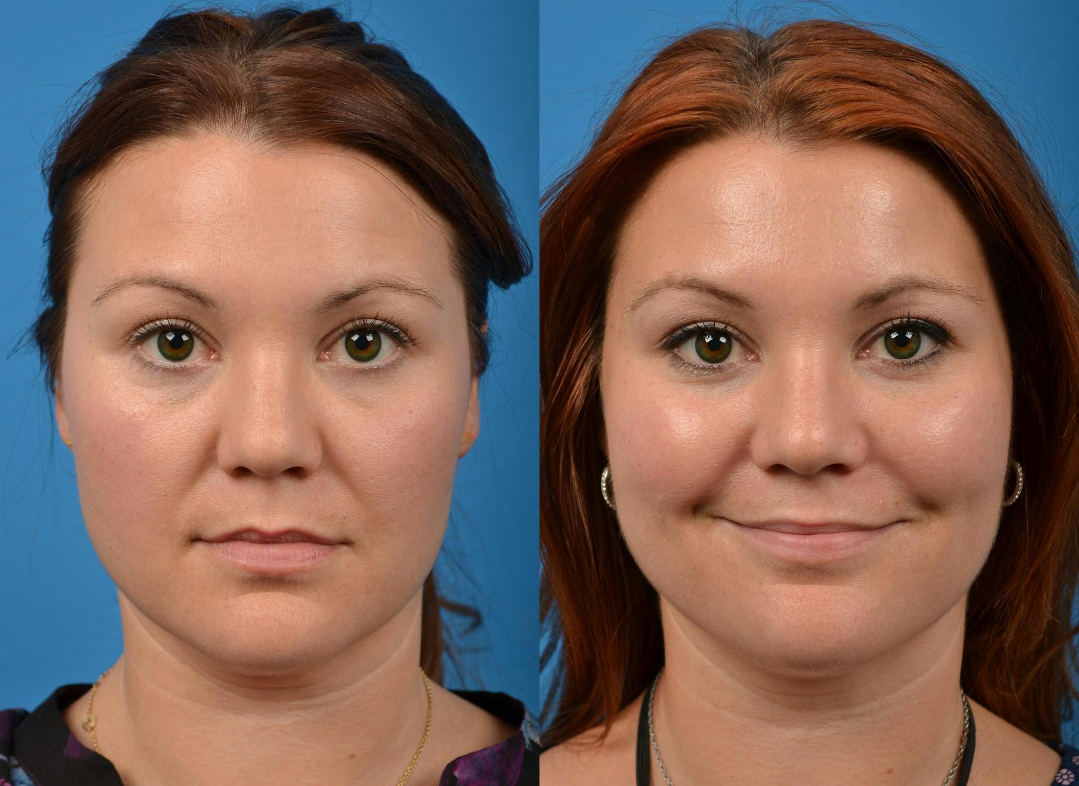 Kybella Before & After Gallery - Patient 122405915 - Image 1