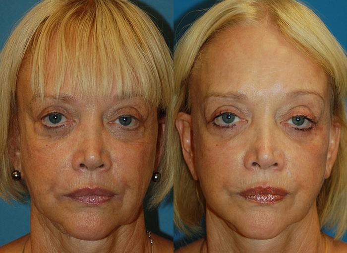 Facelift Before & After Gallery - Patient 122405911 - Image 1