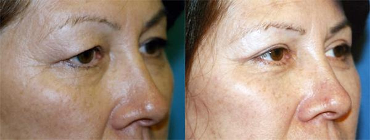 Eyelid Surgery Before & After Gallery - Patient 122405910 - Image 2