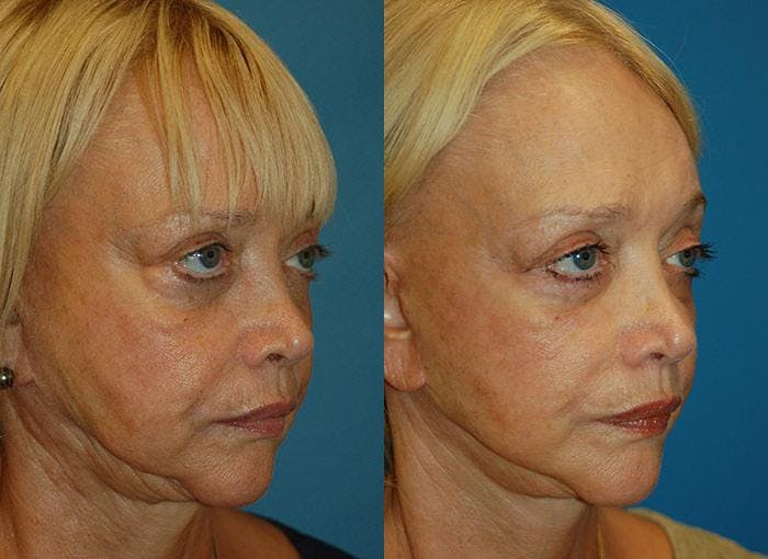Facelift Before & After Gallery - Patient 122405911 - Image 2