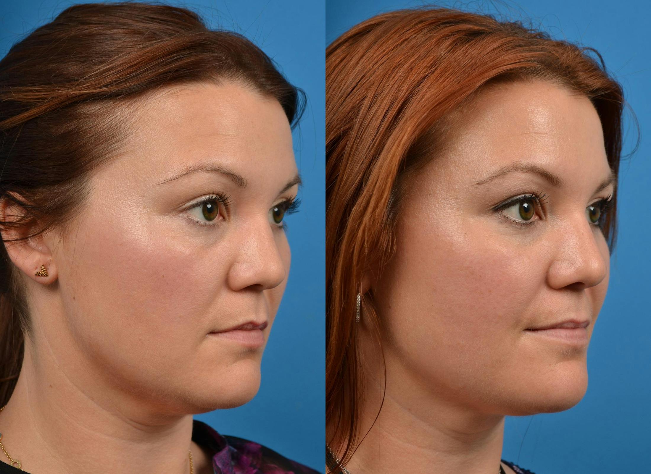 Kybella Before & After Gallery - Patient 122405915 - Image 2