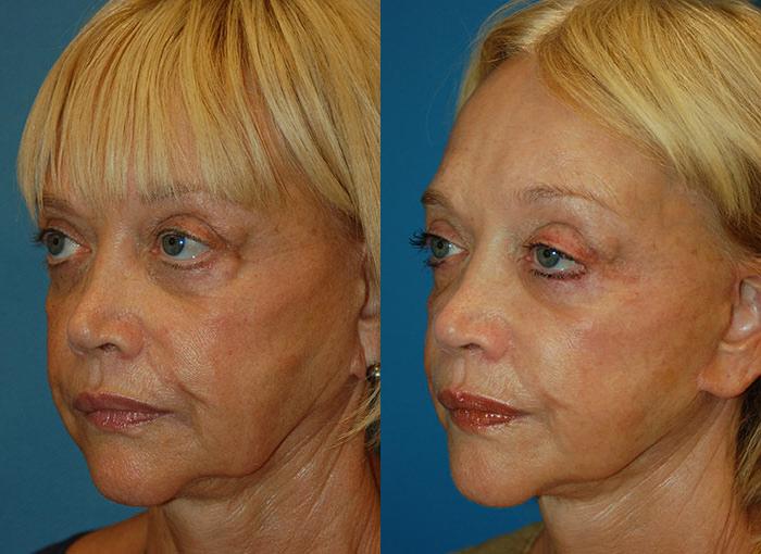 Facelift Before & After Gallery - Patient 122405911 - Image 3