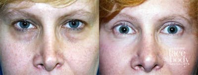 Eyelid Surgery Before & After Gallery - Patient 372045 - Image 1