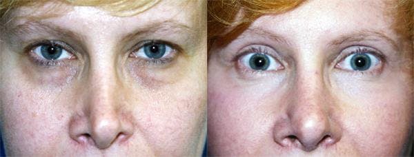 Eyelid Surgery Before & After Gallery - Patient 122405912 - Image 1