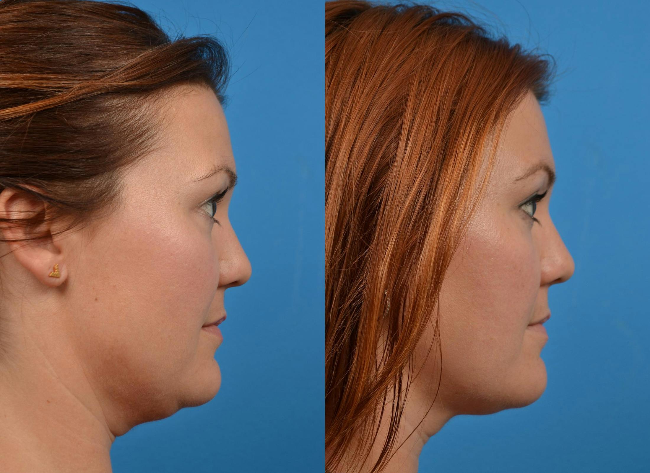 Kybella Before & After Gallery - Patient 122405915 - Image 3