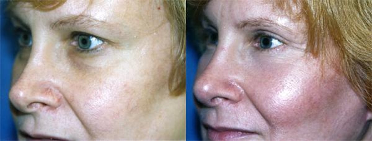 Eyelid Surgery Before & After Gallery - Patient 122405912 - Image 2