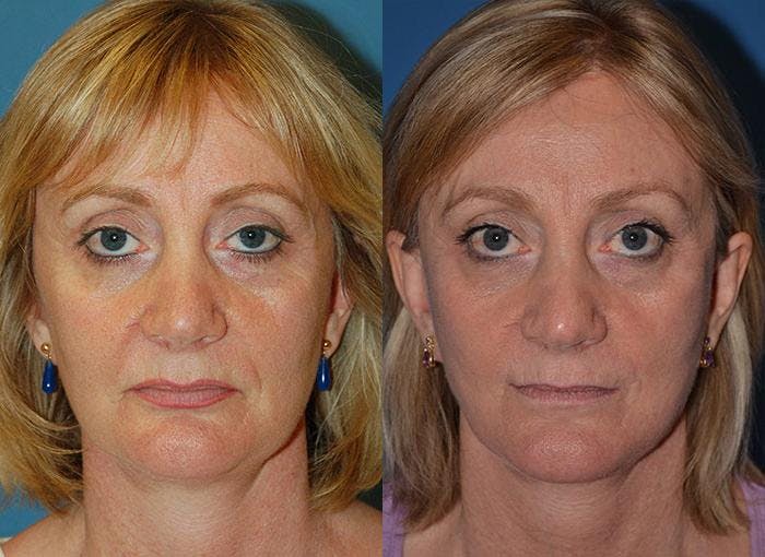 Facelift Before & After Gallery - Patient 122405914 - Image 1