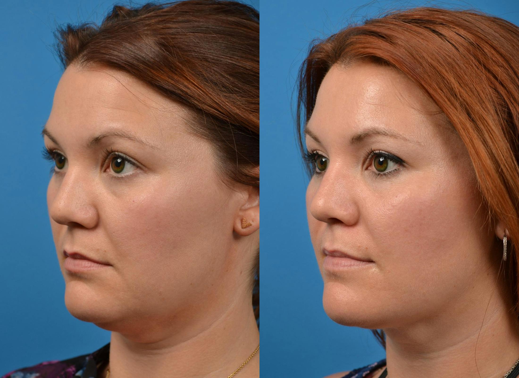 Kybella Before & After Gallery - Patient 122405915 - Image 4