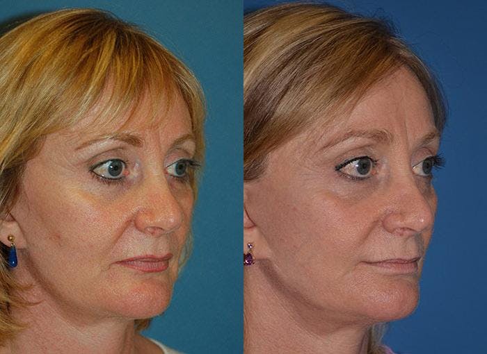 Facelift Before & After Gallery - Patient 122405914 - Image 2