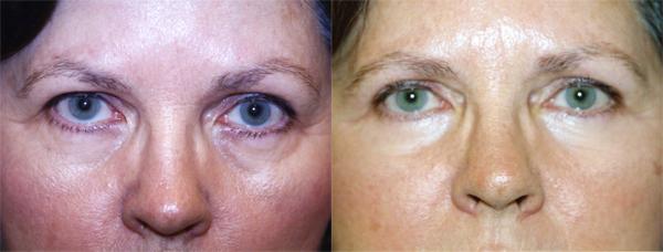 Eyelid Surgery Before & After Gallery - Patient 337675 - Image 1