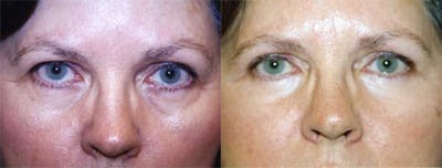 Eyelid Surgery Before & After Gallery - Patient 122405913 - Image 1