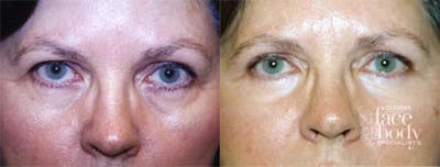 Eyelid Surgery Before & After Gallery - Patient 337675 - Image 1