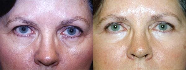 Eyelid Surgery Before & After Gallery - Patient 122405913 - Image 1