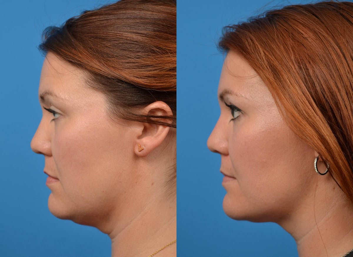 Kybella Before & After Gallery - Patient 122405915 - Image 5