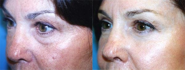 Eyelid Surgery Before & After Gallery - Patient 122405913 - Image 2