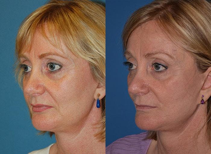 Facelift Before & After Gallery - Patient 122405914 - Image 3