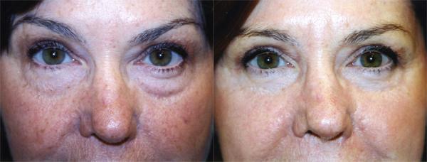 Eyelid Surgery Before & After Gallery - Patient 204274 - Image 1