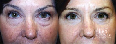 Eyelid Surgery Before & After Gallery - Patient 204274 - Image 1