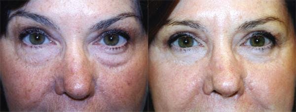 Eyelid Surgery Before & After Gallery - Patient 122405916 - Image 1