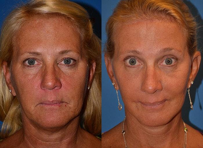 Facelift Before & After Gallery - Patient 122405918 - Image 1