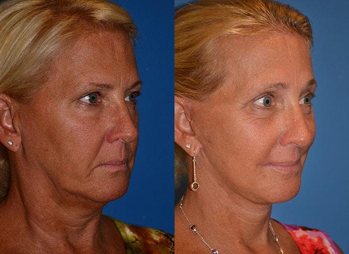Facelift Before & After Gallery - Patient 122405918 - Image 2