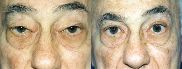 Eyelid Surgery Before & After Gallery - Patient 122405917 - Image 1