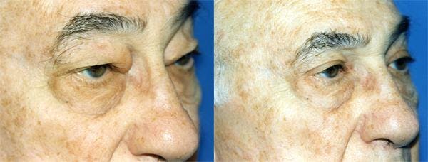 Eyelid Surgery Before & After Gallery - Patient 122405917 - Image 2