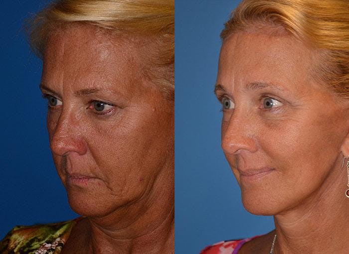 Facelift Before & After Gallery - Patient 122405918 - Image 3