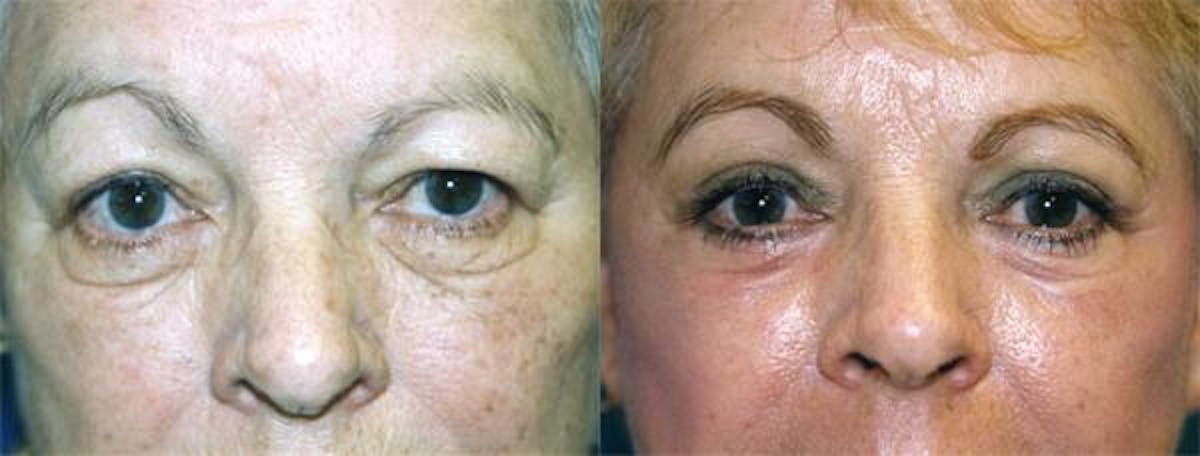 Eyelid Surgery Before & After Gallery - Patient 122405919 - Image 1