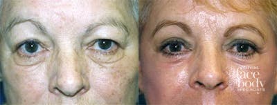 Eyelid Surgery Before & After Gallery - Patient 254853 - Image 1