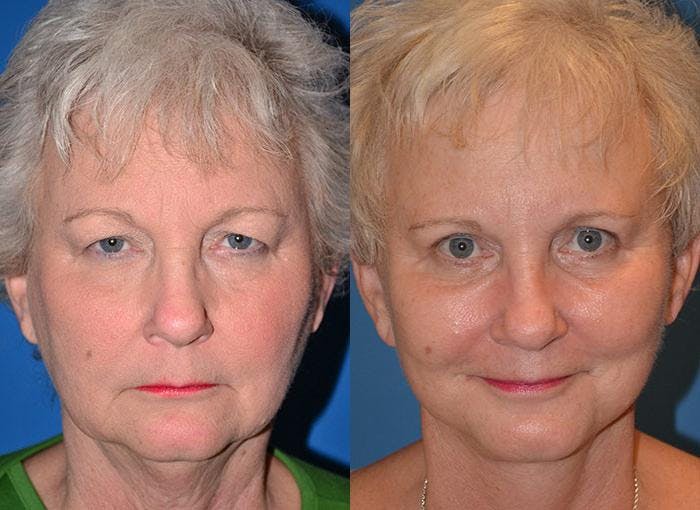Facelift Before & After Gallery - Patient 122405920 - Image 1