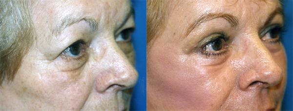 Eyelid Surgery Before & After Gallery - Patient 122405919 - Image 2