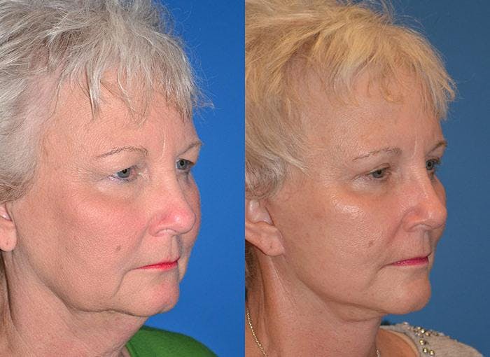 Facelift Before & After Gallery - Patient 122405920 - Image 2