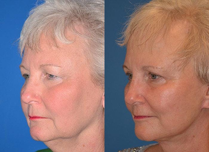 Facelift Before & After Gallery - Patient 122405920 - Image 3
