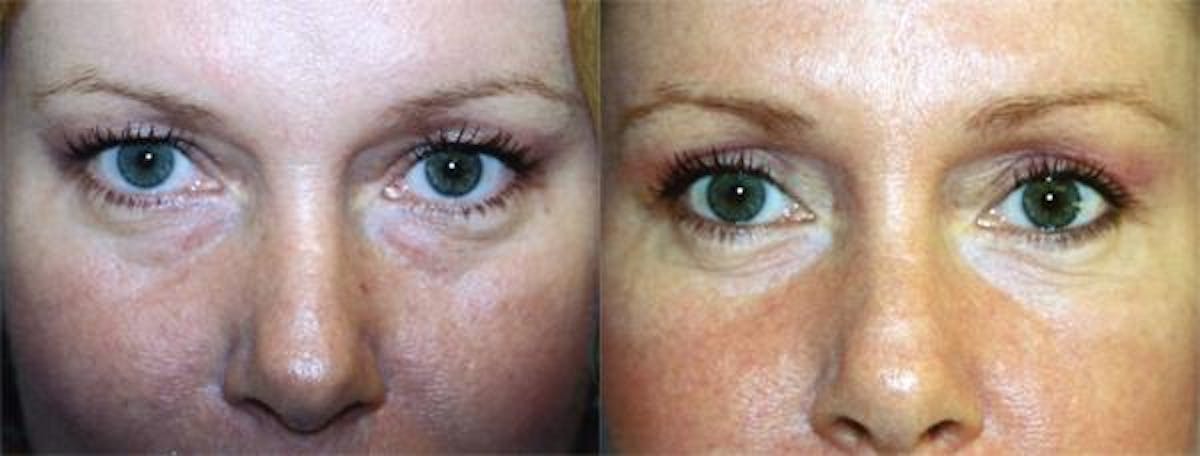 Eyelid Surgery Before & After Gallery - Patient 122405921 - Image 1