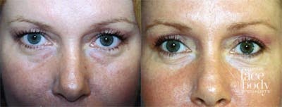 Eyelid Surgery Before & After Gallery - Patient 180092 - Image 1