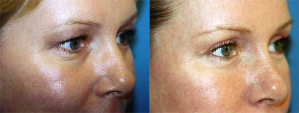 Eyelid Surgery Before & After Gallery - Patient 180092 - Image 2