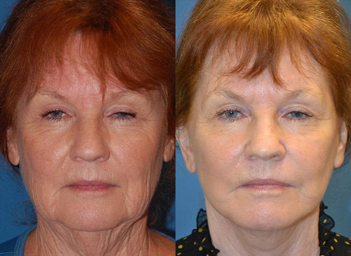 Facelift Before & After Gallery - Patient 122405923 - Image 1
